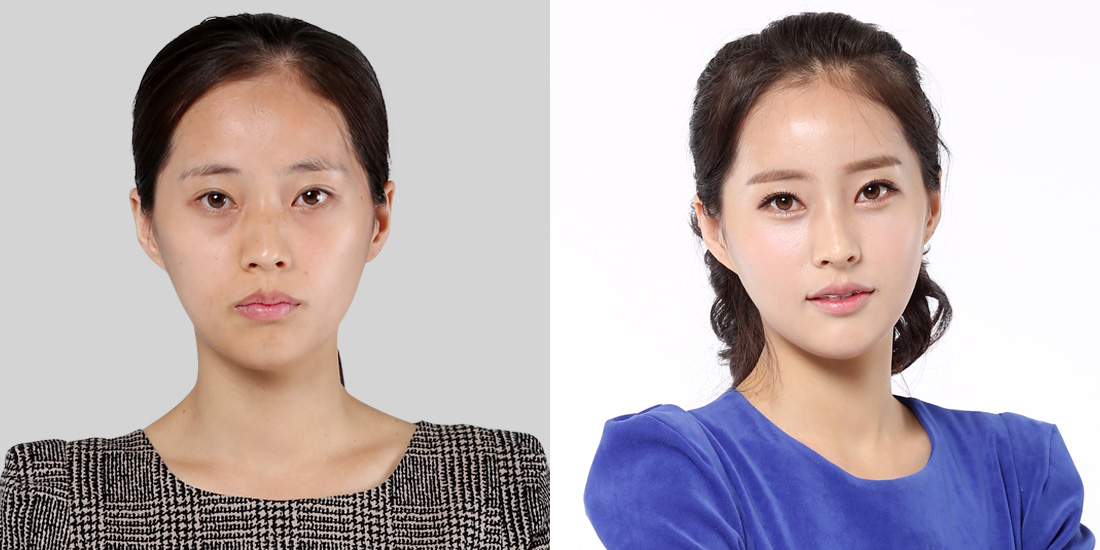 눈밑지방재배치