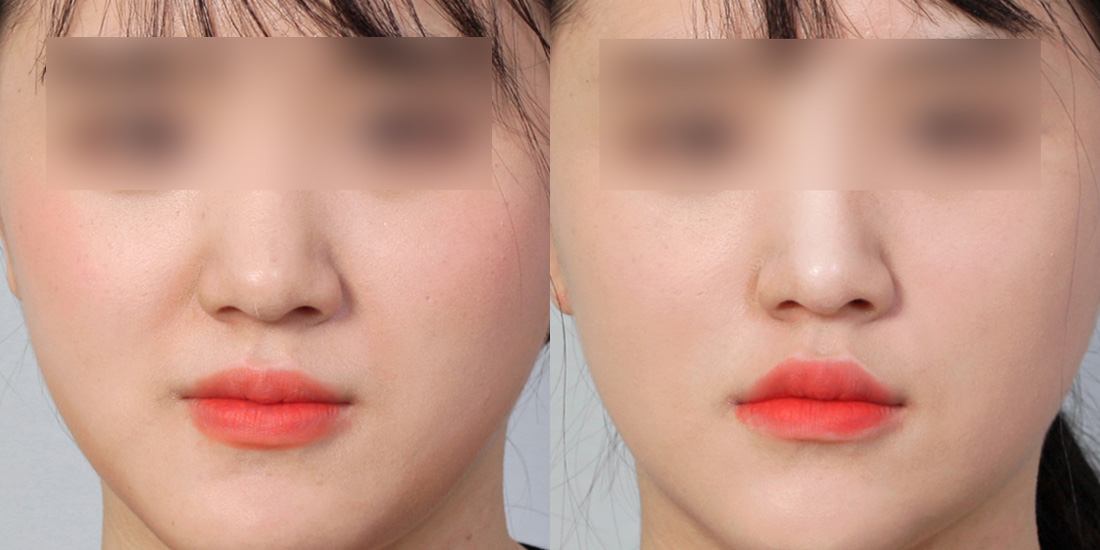 팔자 필러