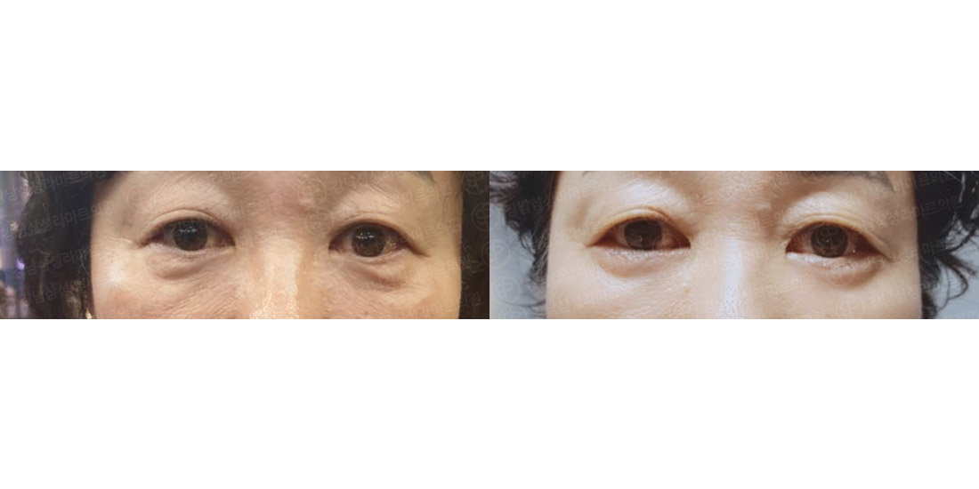 하안검