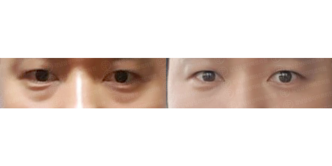 눈밑지방재배치