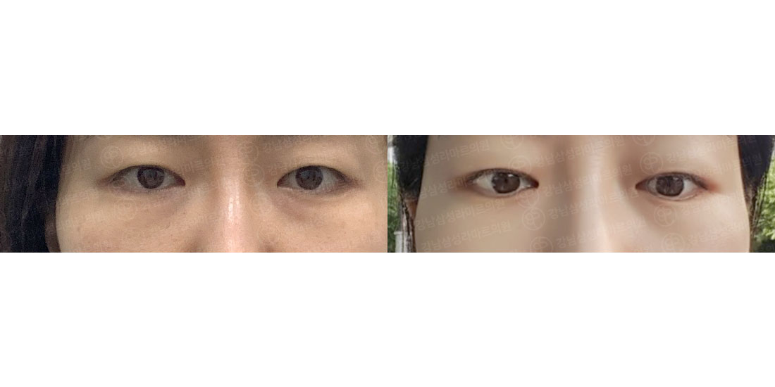 눈밑지방재배치
