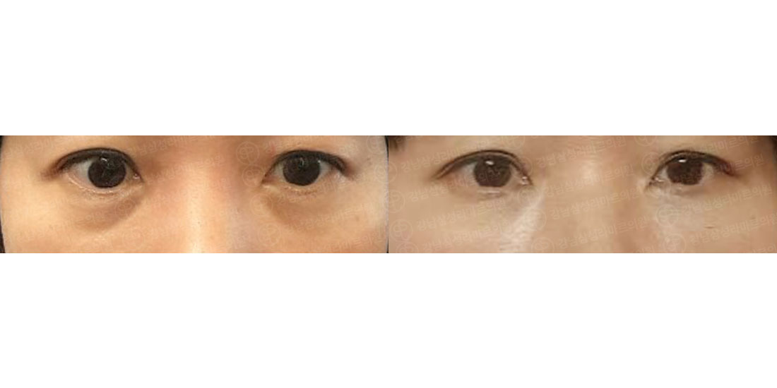 눈밑지방재배치