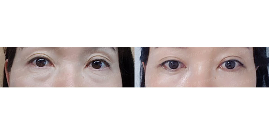 하안검