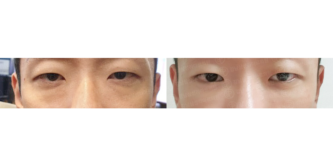 눈밑지방재배치