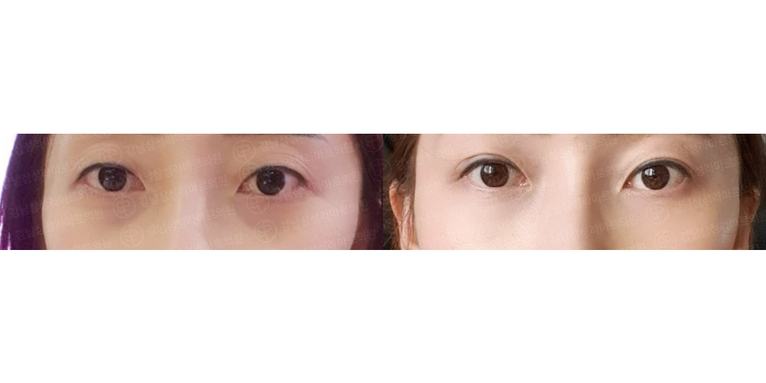 눈밑지방재배치