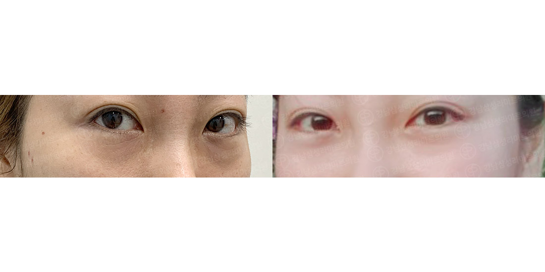 눈밑지방재배치
