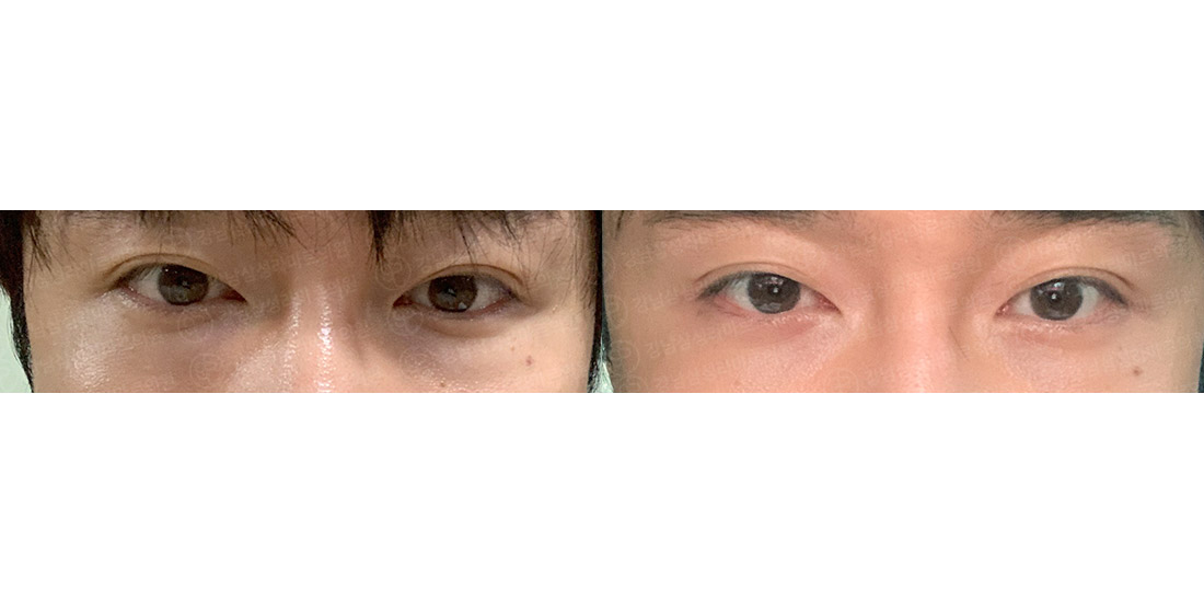 눈밑지방재배치