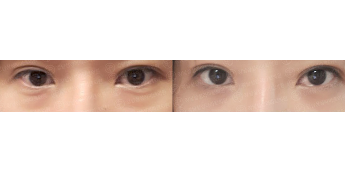 눈밑지방재배치