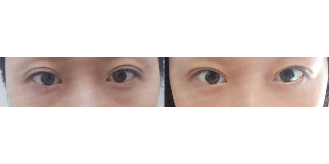 눈밑지방재배치
