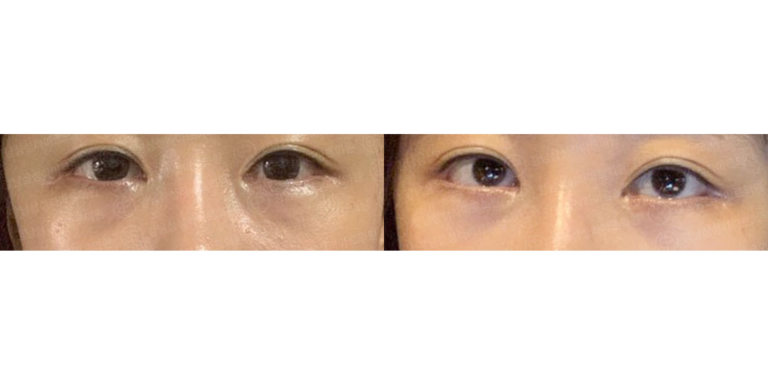 눈밑지방재배치