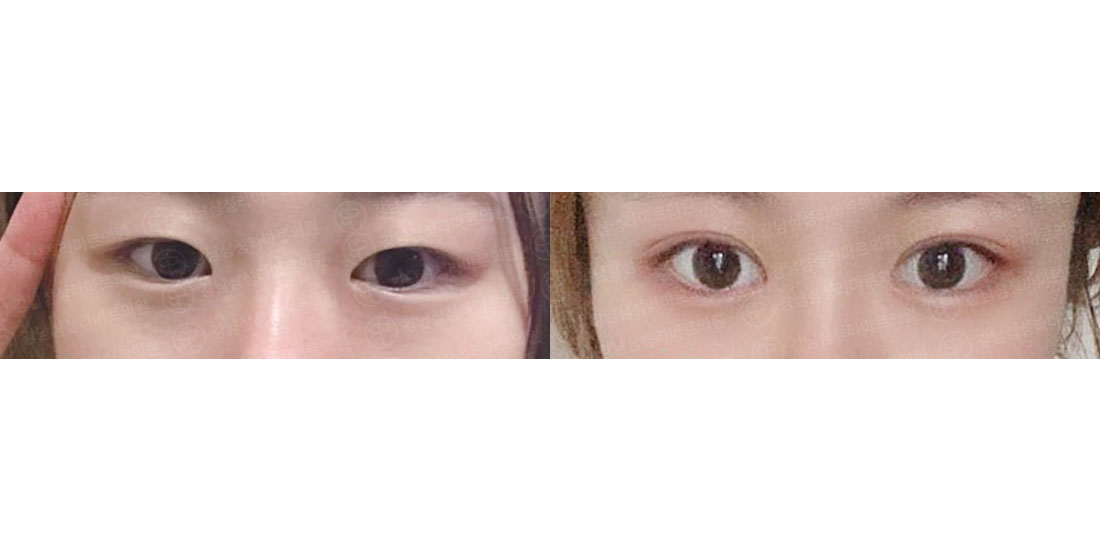쌍꺼풀
