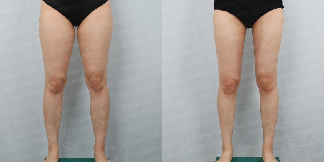 허벅지+종아리 지방흡입