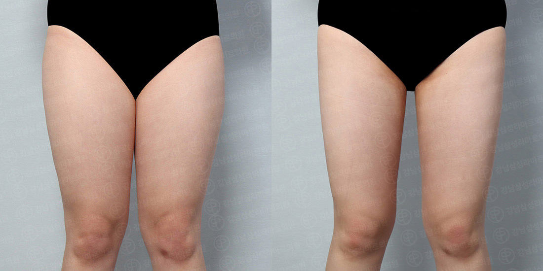 허벅지/엉덩이/무릎라인 지방흡입