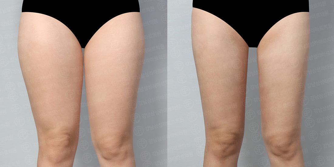 허벅지/엉덩이/무릎라인 지방흡입