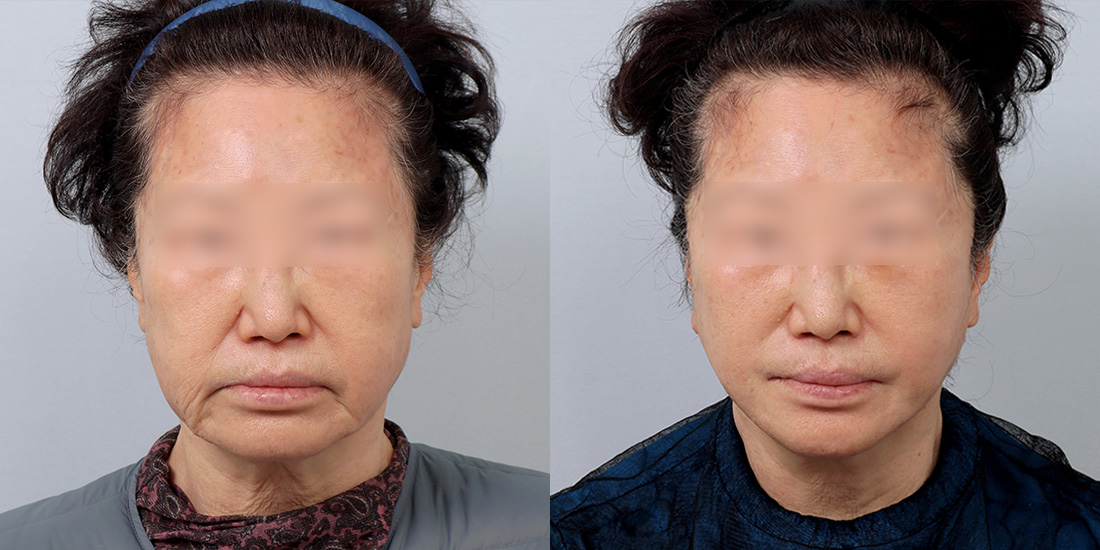 턱선미니안면거상