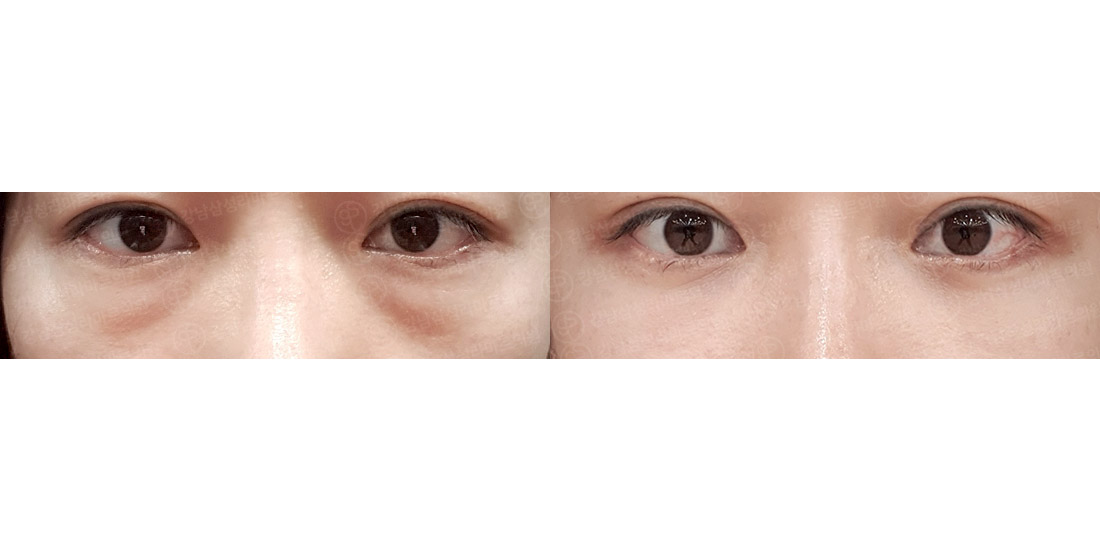 눈밑지방재배치