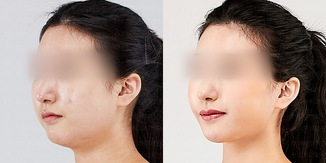 얼굴지방흡입