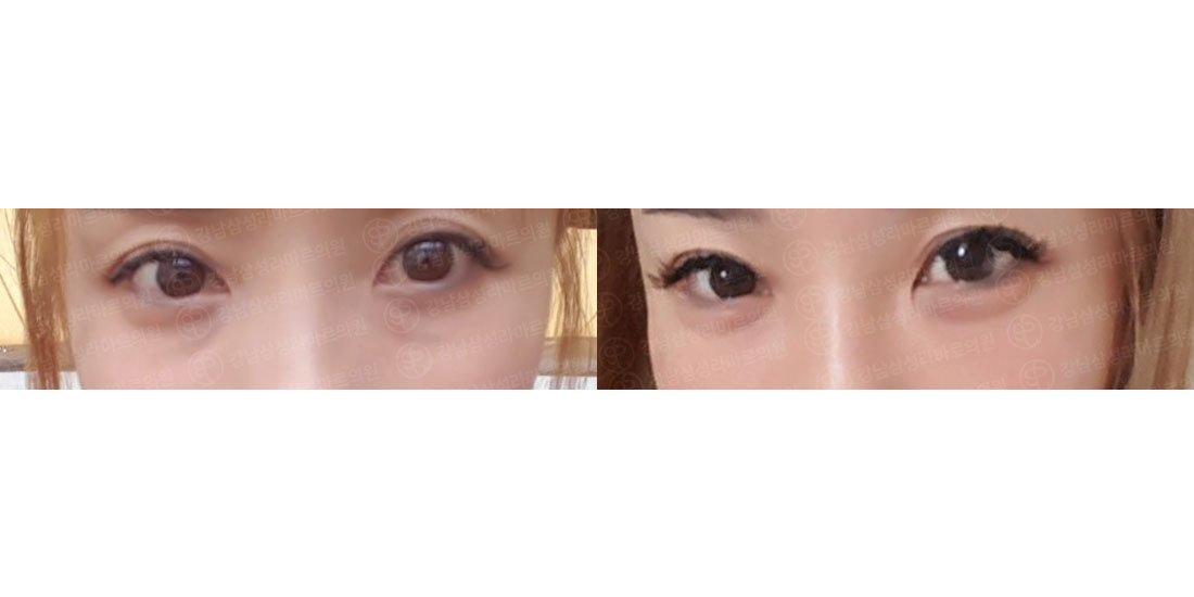 눈밑지방재배치