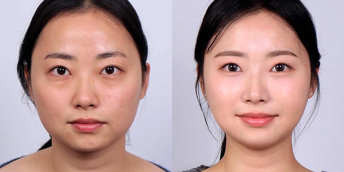 눈밑지방재배치