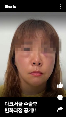 다크서클 수술 후 변화과정 공개!