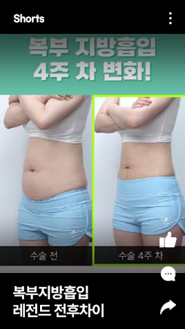 복부지방흡입 레전드 전후차이