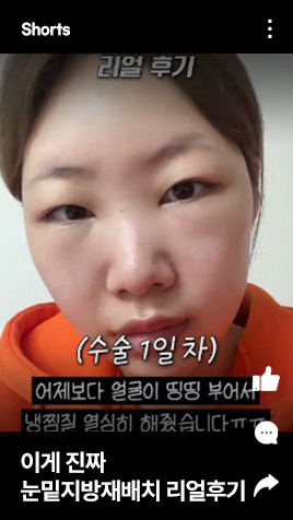 이게 진짜 눈밑지방재배치 리얼후기