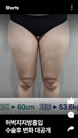 허벅지지방흡입 수술후 변화 대공개