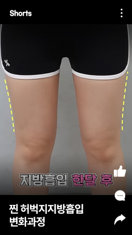찐 허벅지지방흡입 변화과정