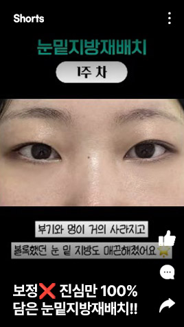 보정x 진심만%담은 눈밑지방재배치!!