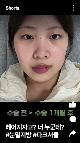 헤어지자고? 너 누군데? #눈밑지방 #다크서
