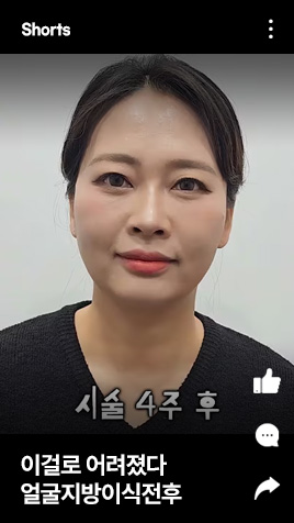 이걸로 어려졌다 얼굴지방이식전후