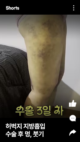 허벅지 지방흡입 수술 후 멍, 붓기