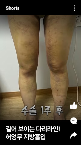 길어 보이는 다리라인! 허엉무 지방흡입