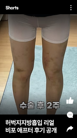허벅지지방흡입 리얼 비포 애프터 후기 공개