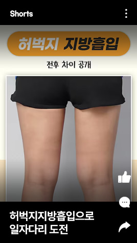 허벅지지방흡입으로