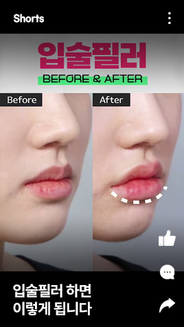 입술필러 하면 이렇게 됩니다