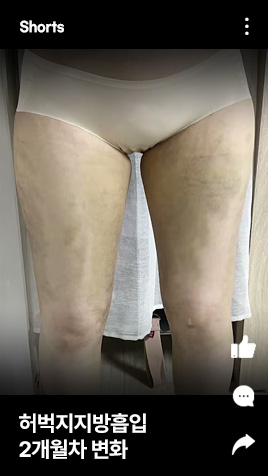 허벅지지방흡입 2개월차 변화