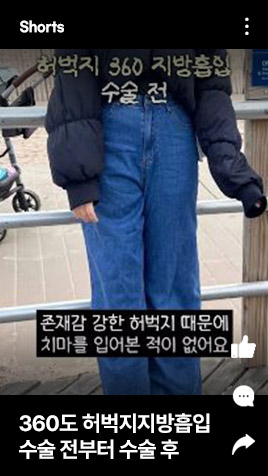 360도허벅지지방흡입 수술 전부터 수술 후