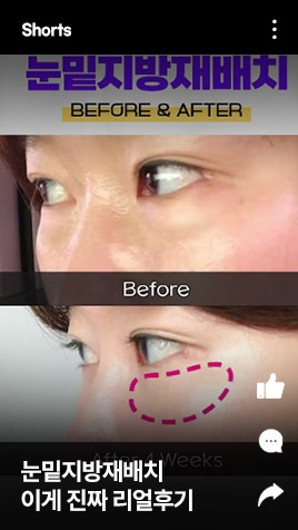 눈밑지방재배치 이게 진짜 리얼후기