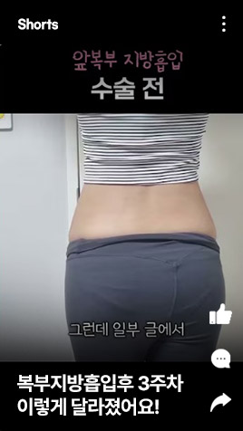복부지방흡입후 3주차 이렇게 달라졌어요!