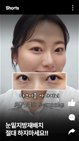 눈밑지방재배치 절대 하지마세요!!