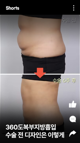 360도복부지방흡입 수술 전 디자인은 이렇게 진행됩니다
