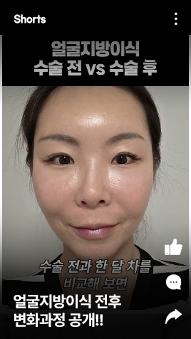 [실제상황]얼굴지방이식 전후 변화과정 공개!! 얼굴에 살 없는 분들 주목!!