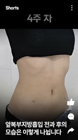 앞복부지방흡입 전과 후의 모습은 이렇게 나뉩니다