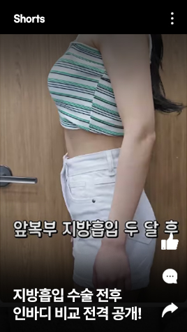 지방흡입 수술 전후 인바디 비교 전격 공개!