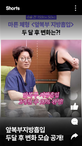 앞복부지방흡입 두달 후 변화 모습 공개! 이렇게 달라집니다