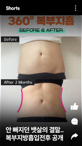 안 빠지던 뱃살의 결말.. 복부지방흡입전후 공개 합니다 (충격결과)