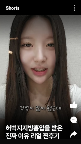허벅지지방흡입을 받은 진짜 이유 리얼 찐후기 보정x 노필터!