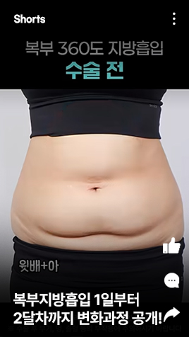 복부지방흡입 수술 전부터 수술 후 1일부터 2달차까지 변화과정 공개!!