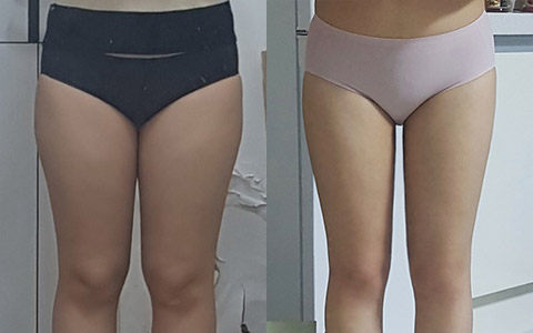 지방흡입 룩팻 8병 (허안) 이미지